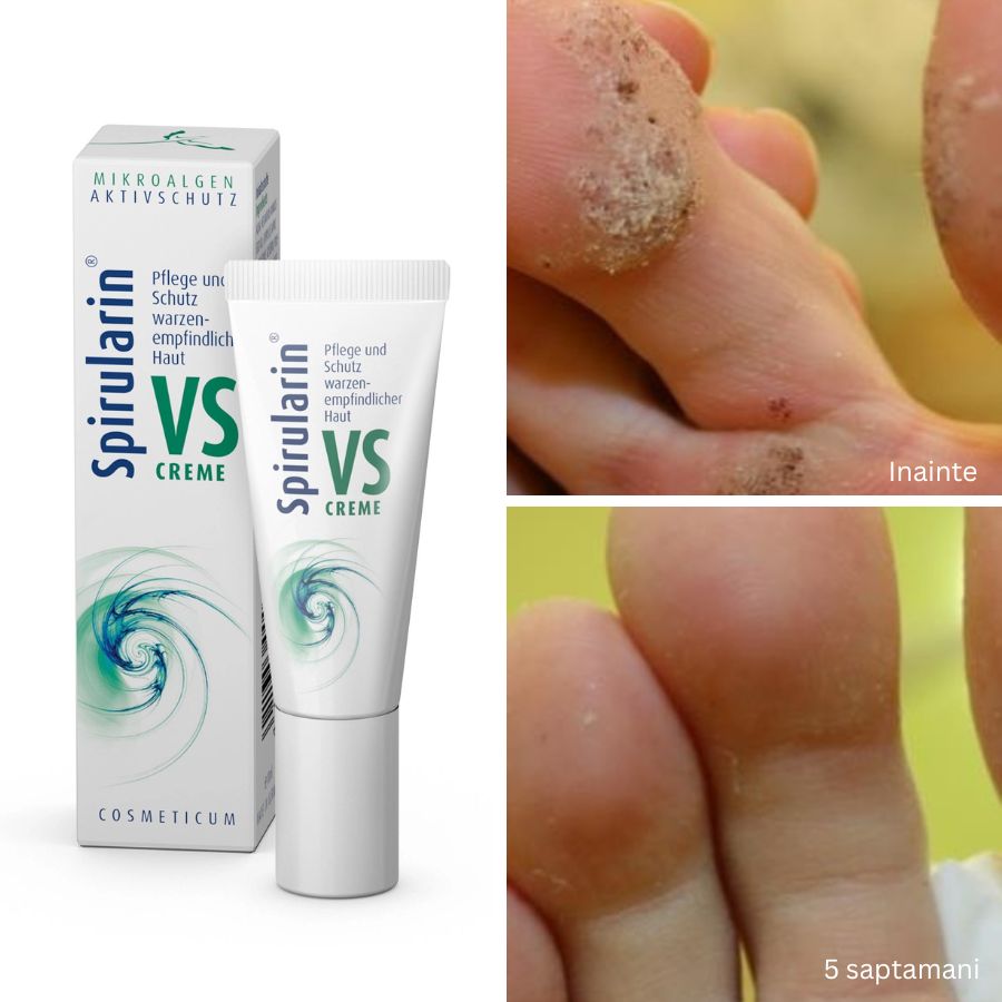 Crema negi/veruci Spirularin® VS, 10 ml