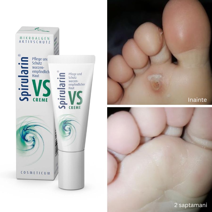 Crema negi/veruci Spirularin® VS, 10 ml
