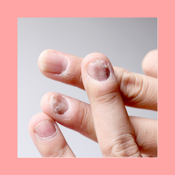 Infectii fungice unghii maini